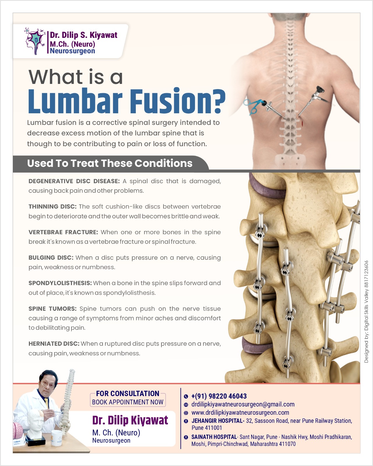 What is a Lumbar Fusion?