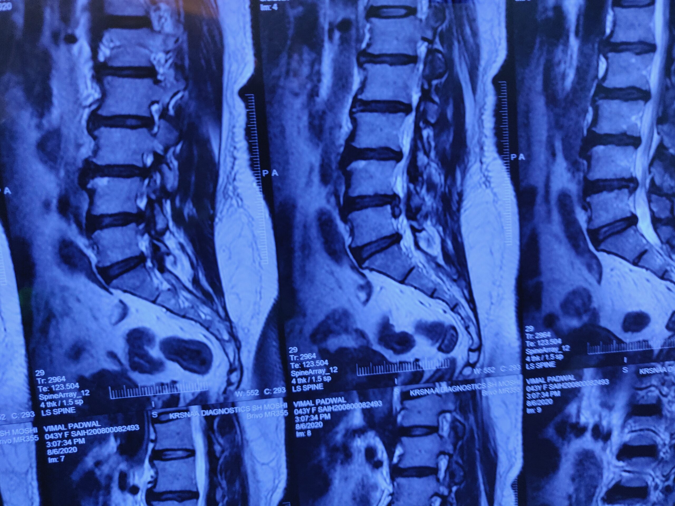 Lumbosacral (LS) Spine MRI Scan