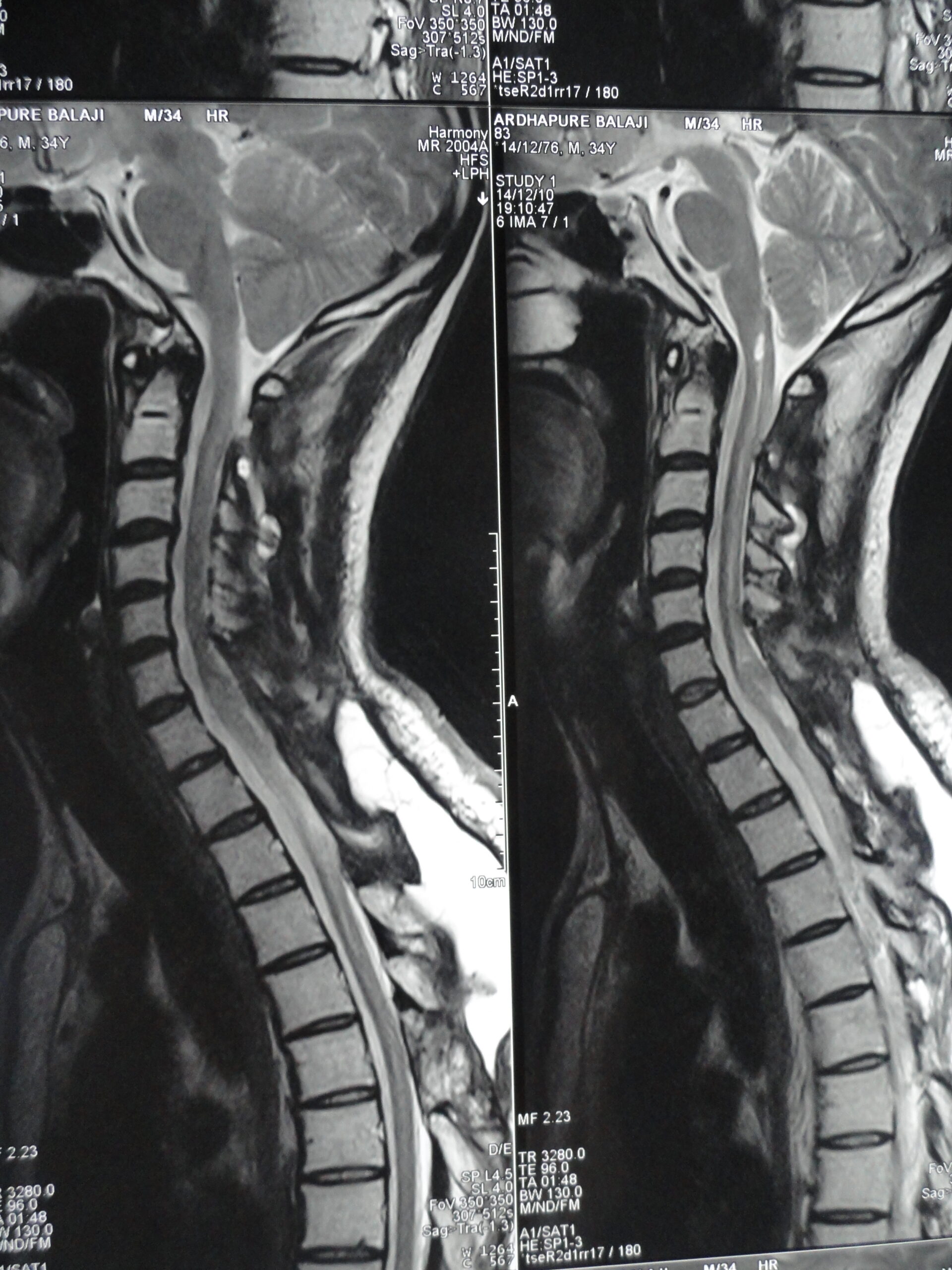 Post-Operative Syrinx Decompression MRI