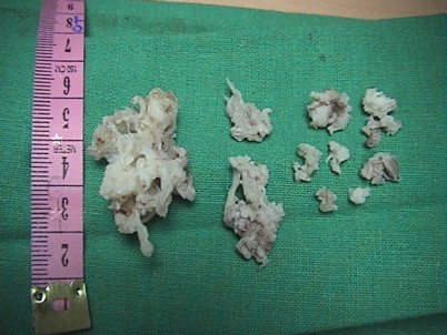 Surgical Pathology Specimen - Resected Tumor