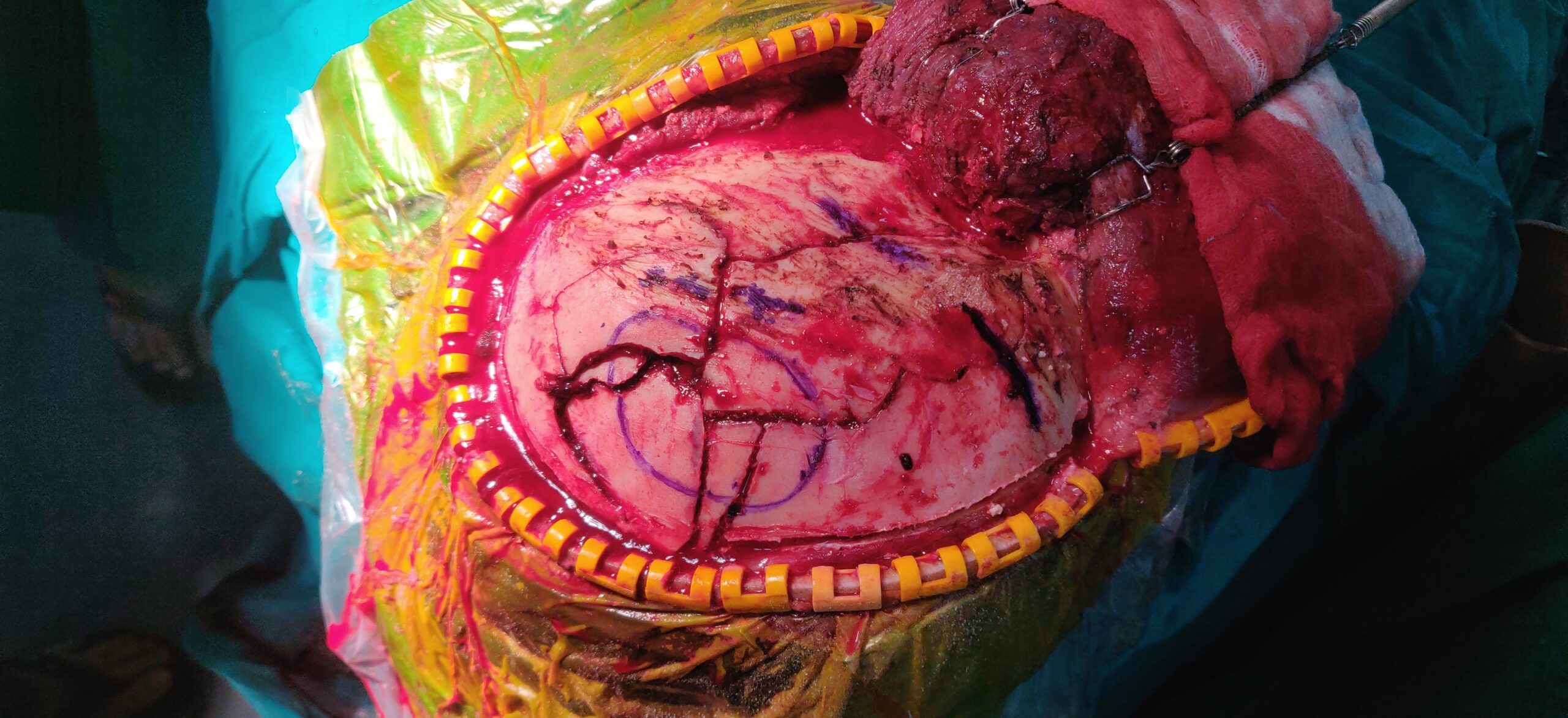 Head Injury