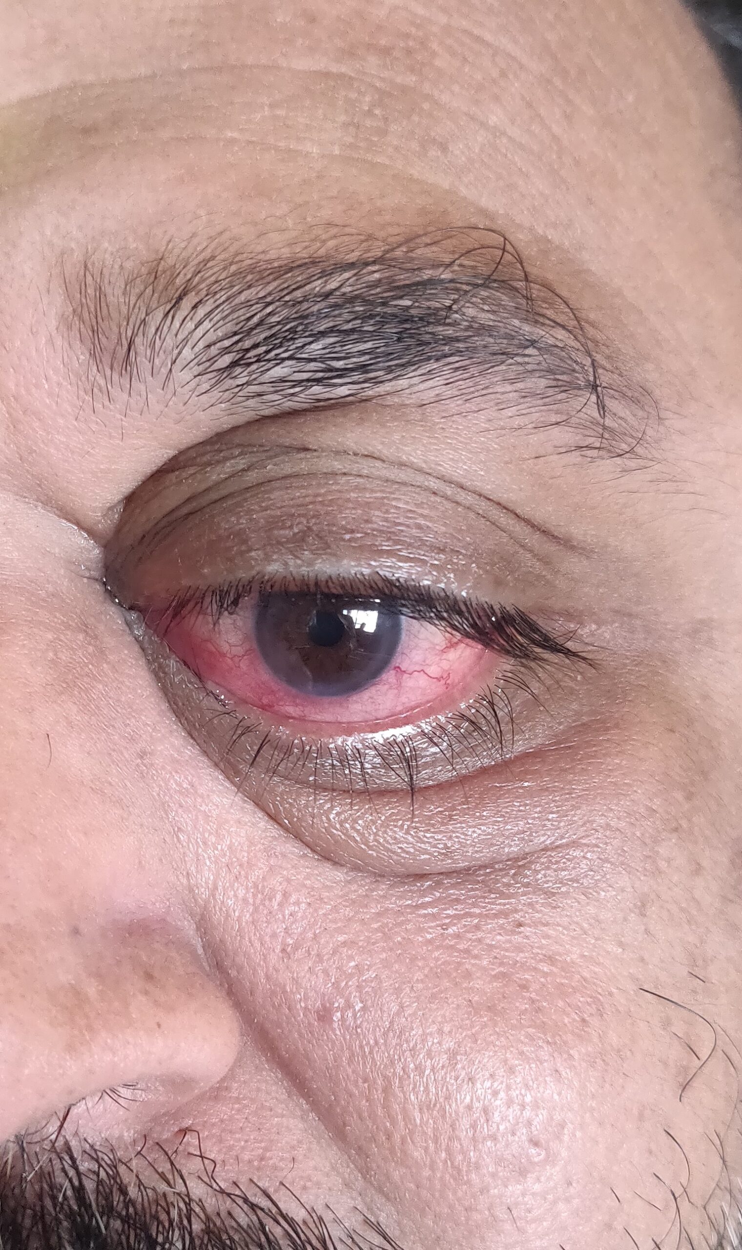 Bulging eye due to thyroid metastasis behind the eye