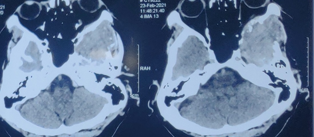 Post Operative Images after removal of metastasis