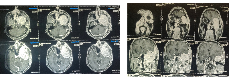 Tumour behind the eye due to Metastasis from the thyroid gland