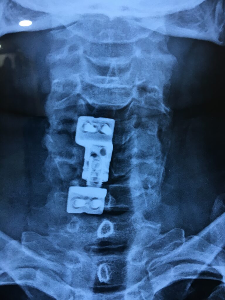 Stabilization done in spinal cord injury View