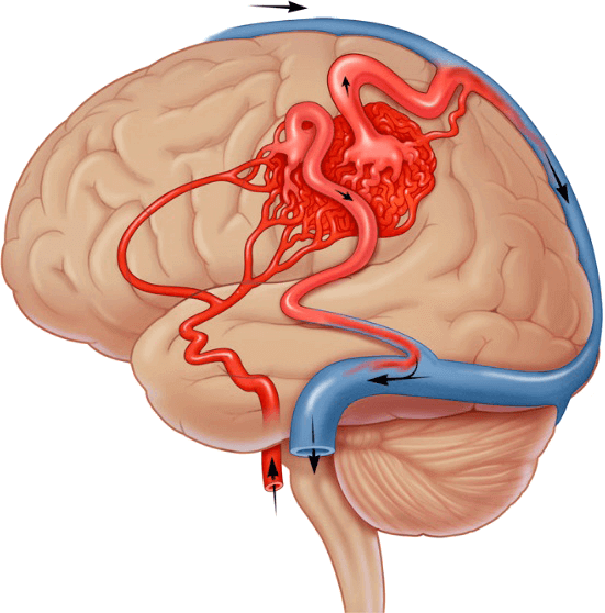 Cerebral Arteriovenous Malformation AVM Diagnostic Scan