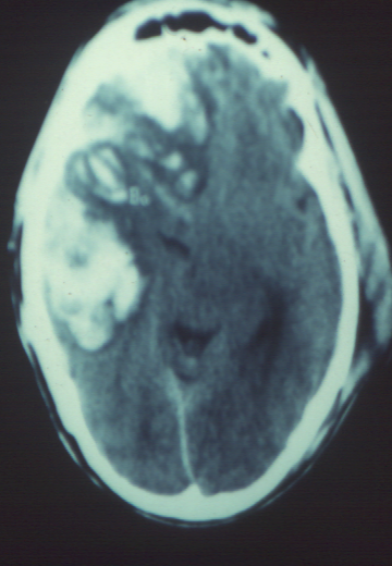 Cerebral haemorrhagic contusion