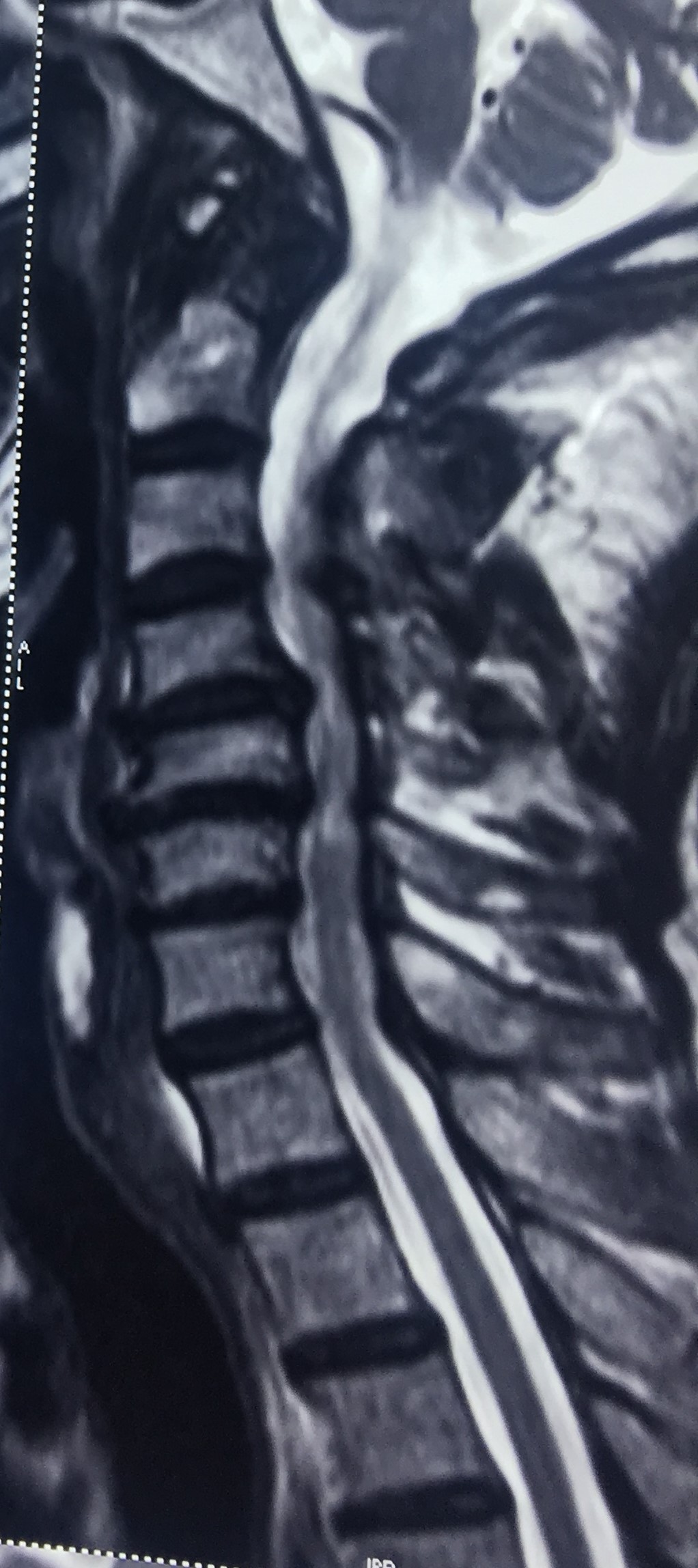 Cervical Disc Bulges with Canal Stenosis and Cord Compression