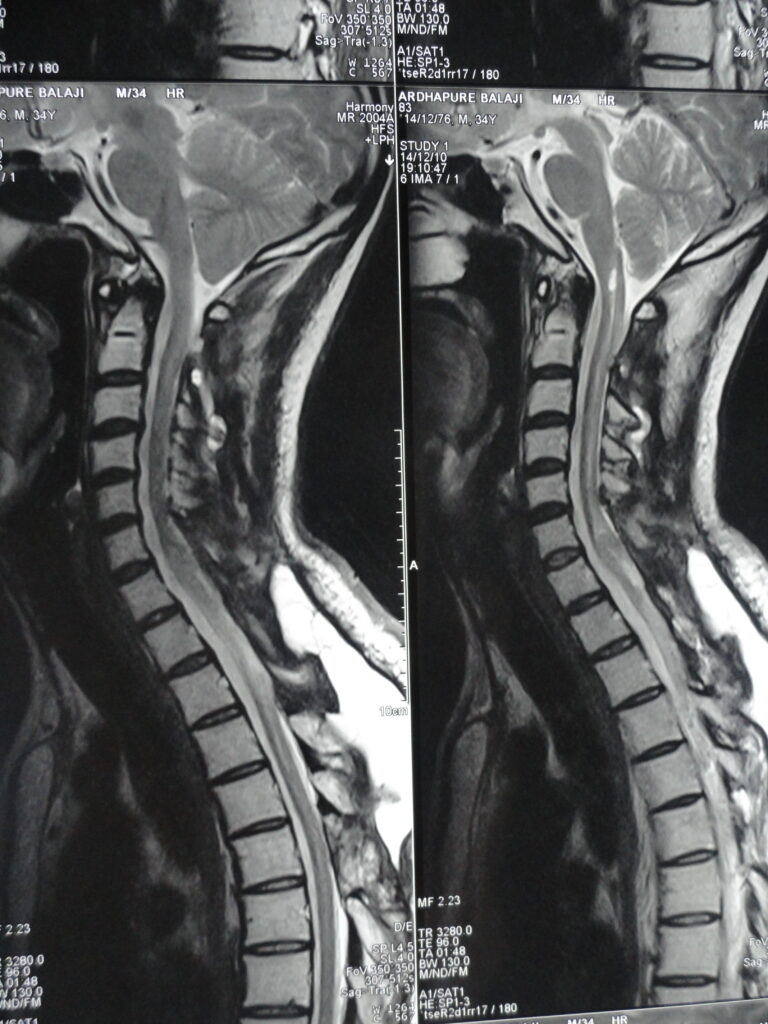 MRI After surgery