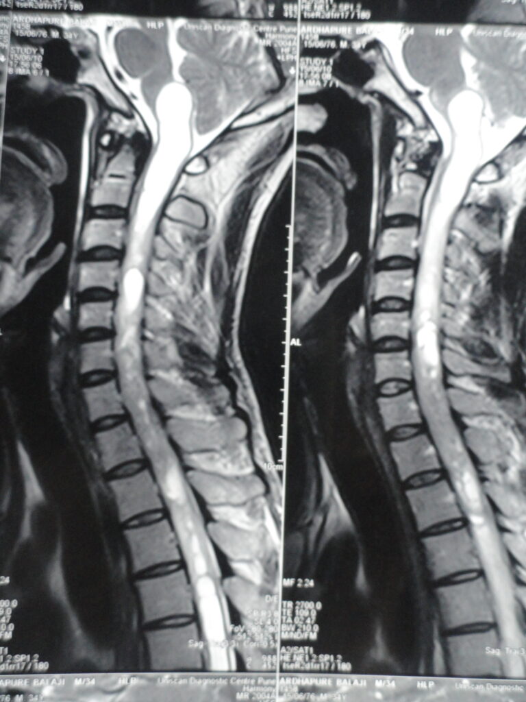 SPINAL cord TUMOR in cervical region