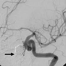 coilig of neurysm
