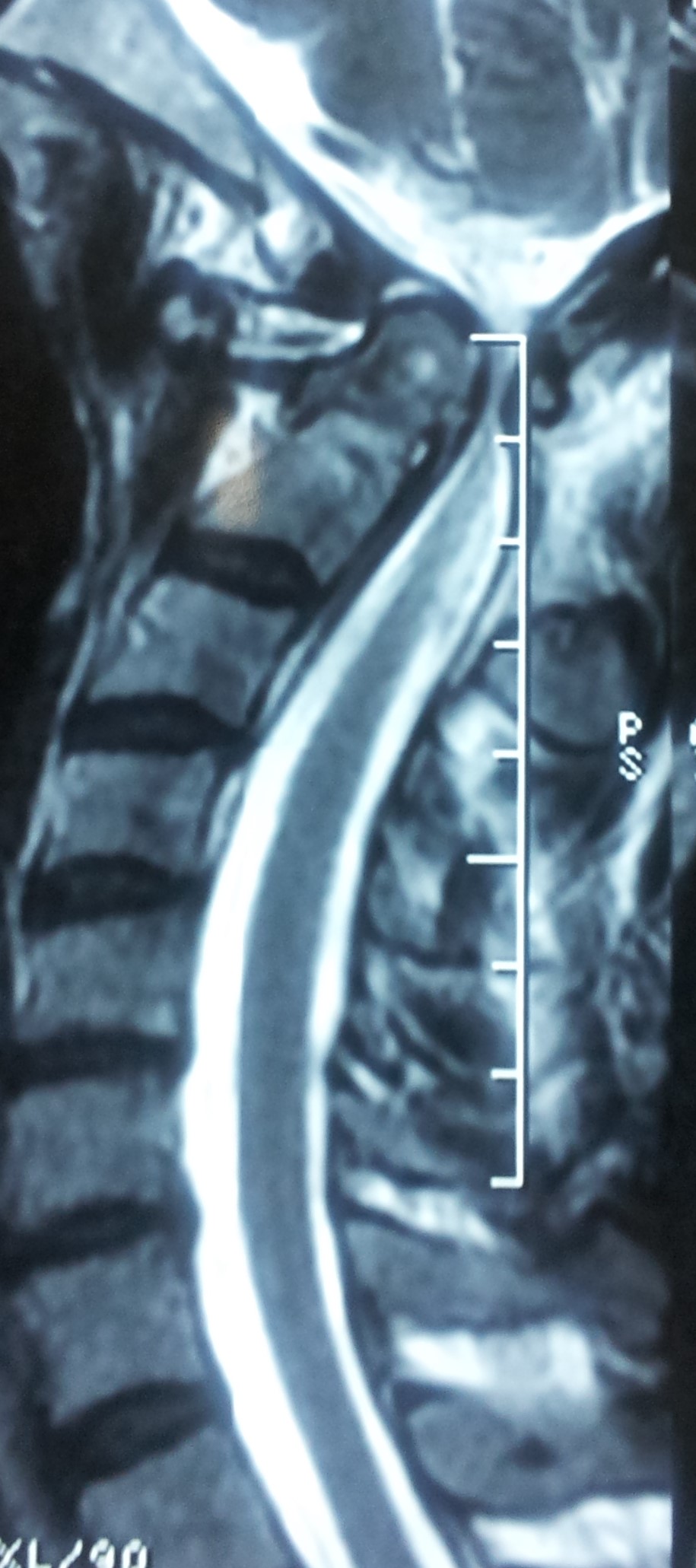 atlanto axial dislocation mri scan