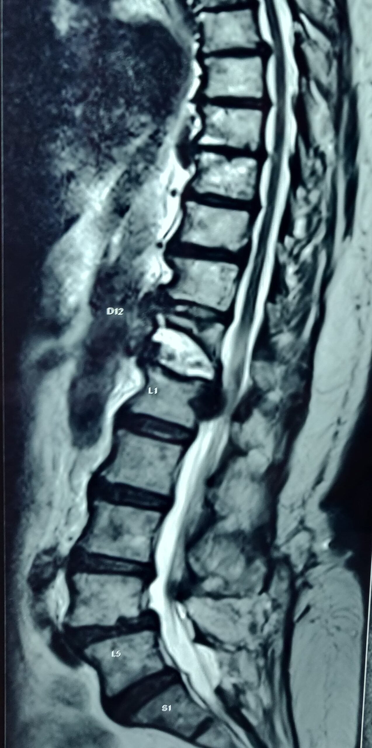 D12 spine compression fracture