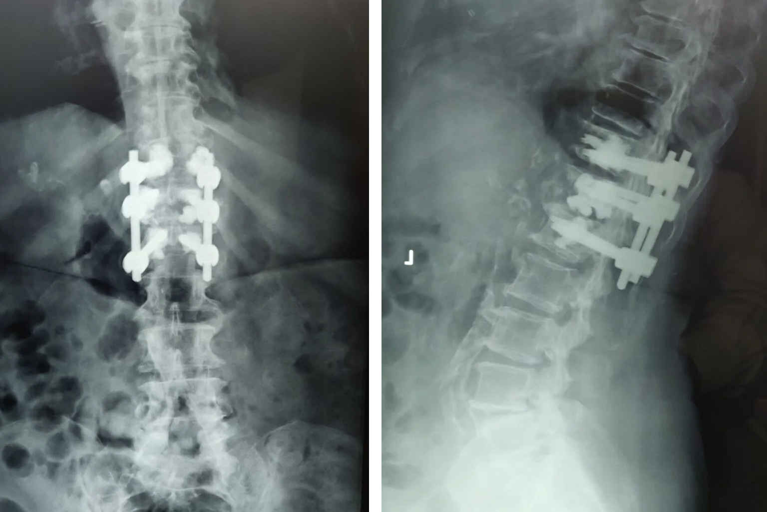 compression fracture stabilization surgery done