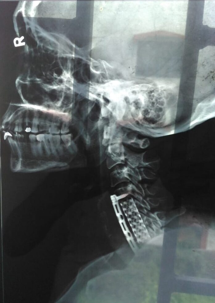 Decompression and stabilization of OPLL done