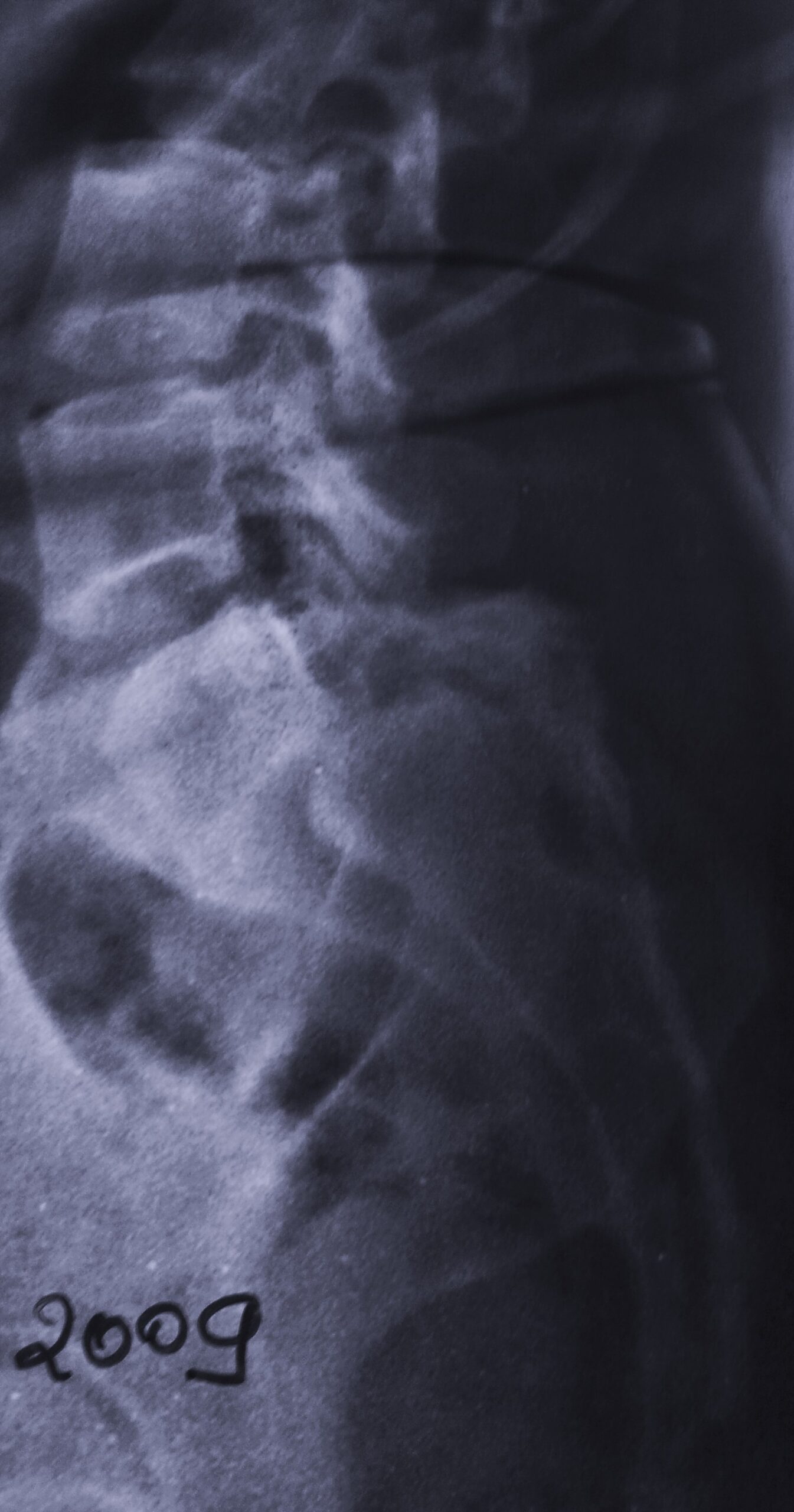 Spondylolisthesis Progression