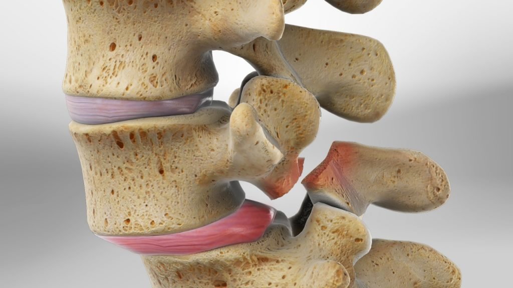 spondylolisthesis