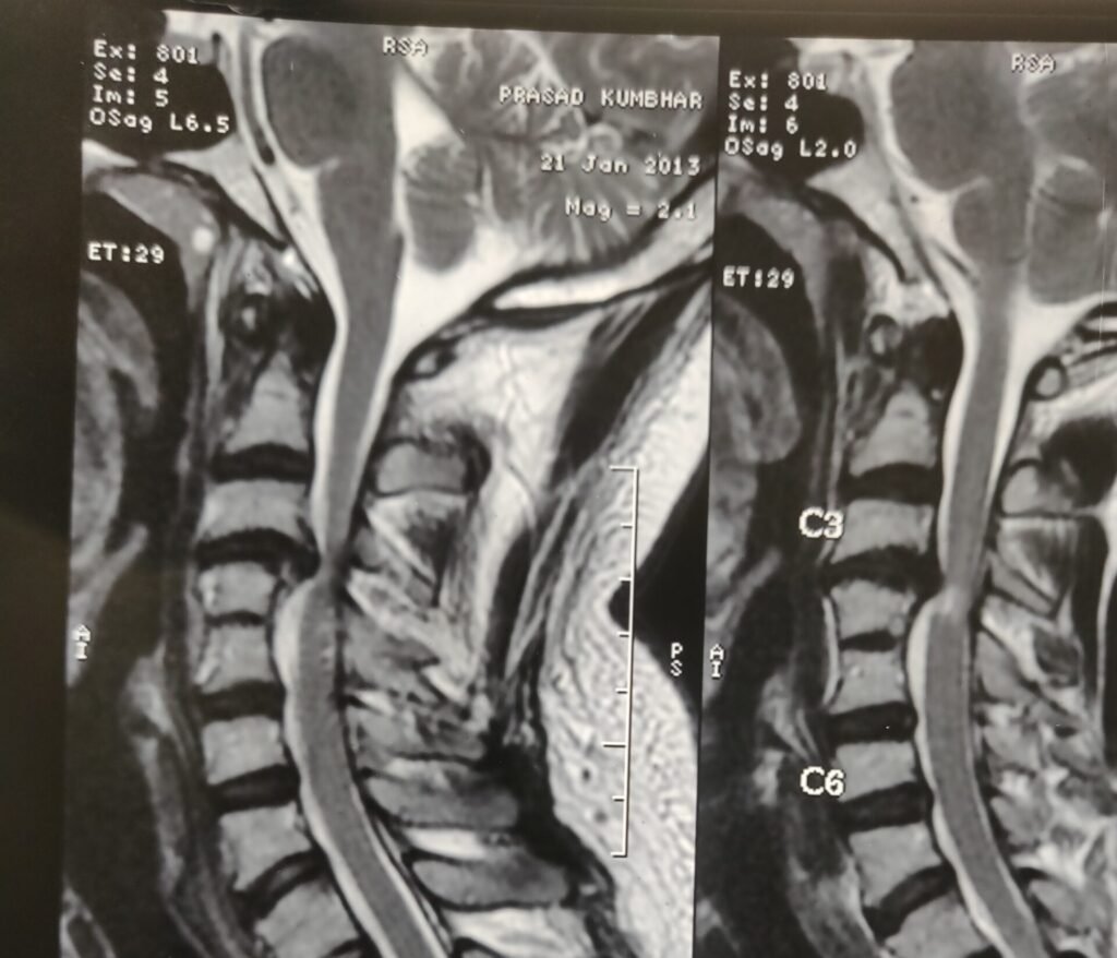 Cervical disc prolapse