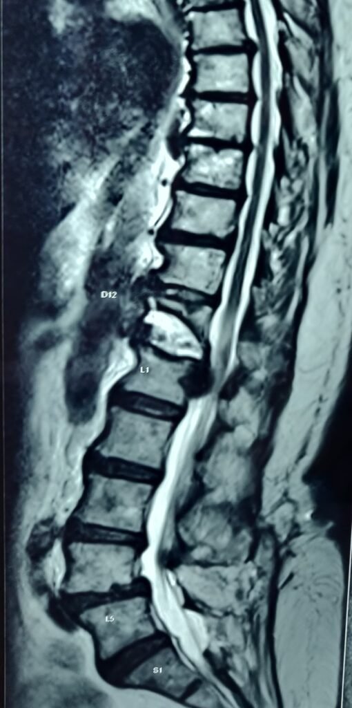 Fracture of spine