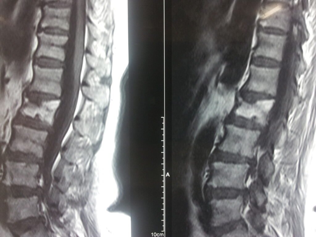 Osteoporotic vertebral collapse