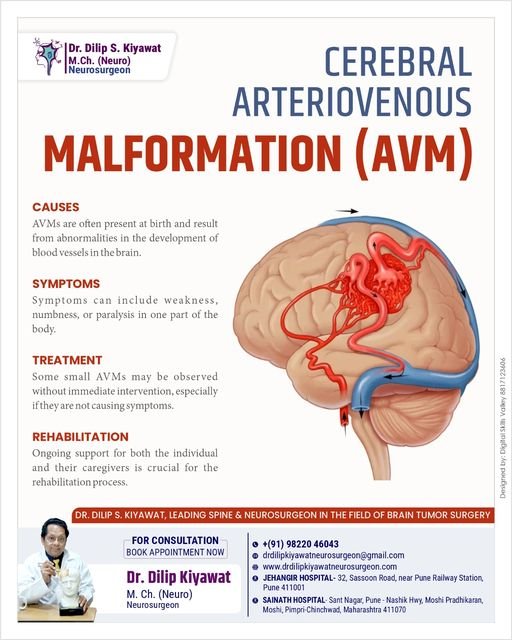 Cerebral Arteriovenous Malformation