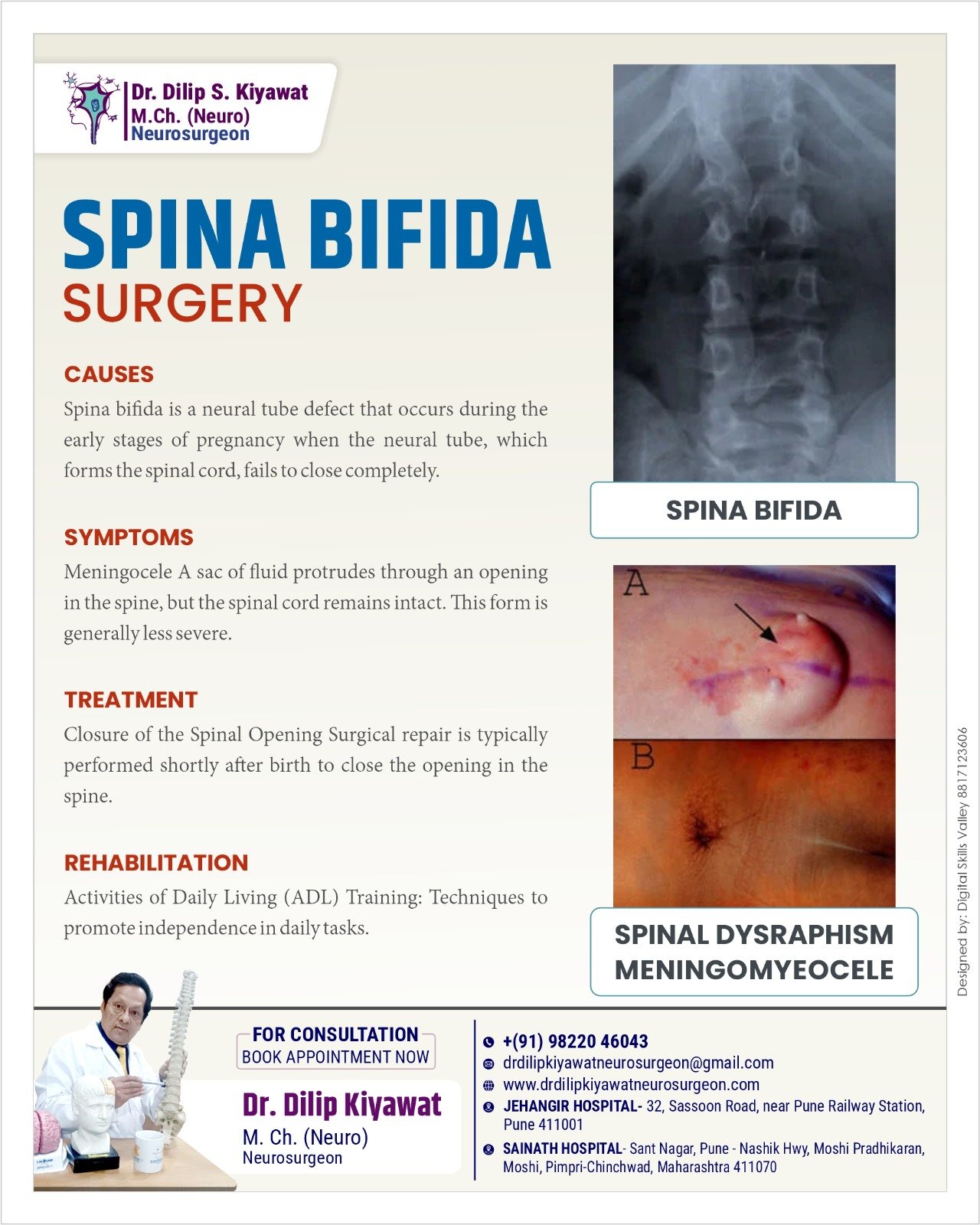 Spina Bifida and Its Surgical Treatment | Dr. Dilip Kiyawat