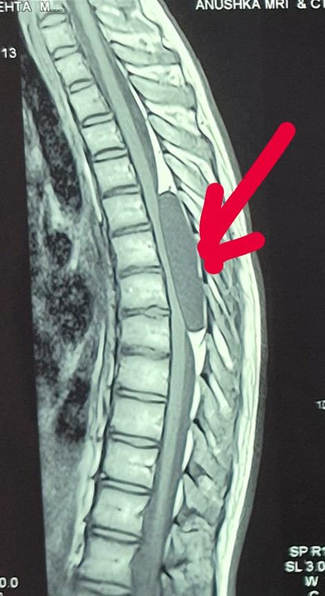 Spinal Extradural Tumor